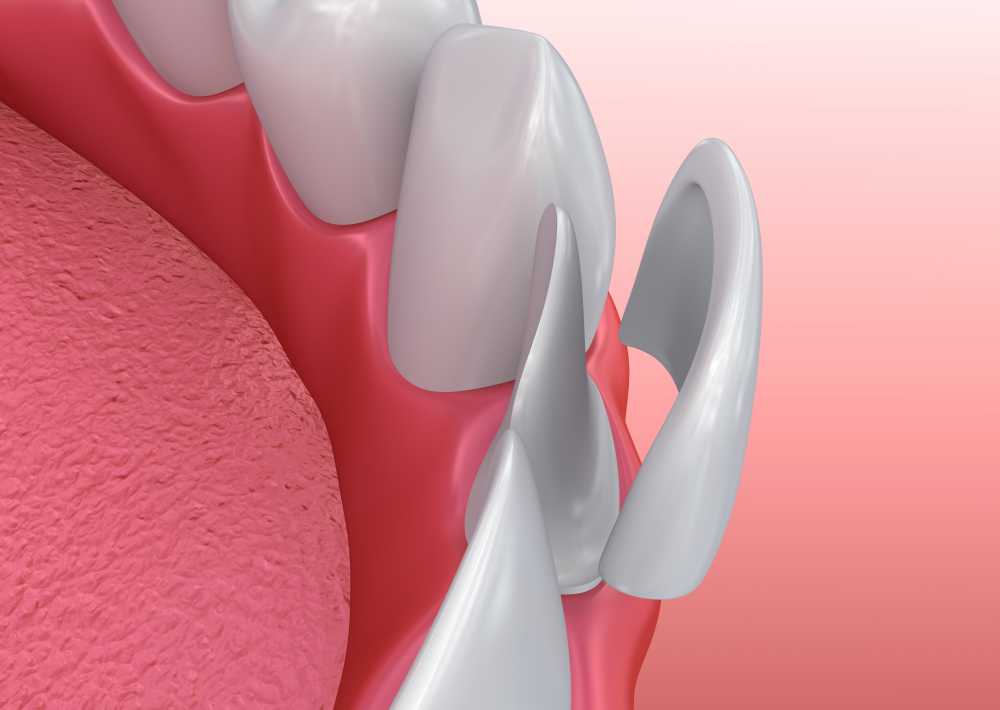 Why is it advisable to get dental Veneers to sort out your dental problems? latestworldtrends.com