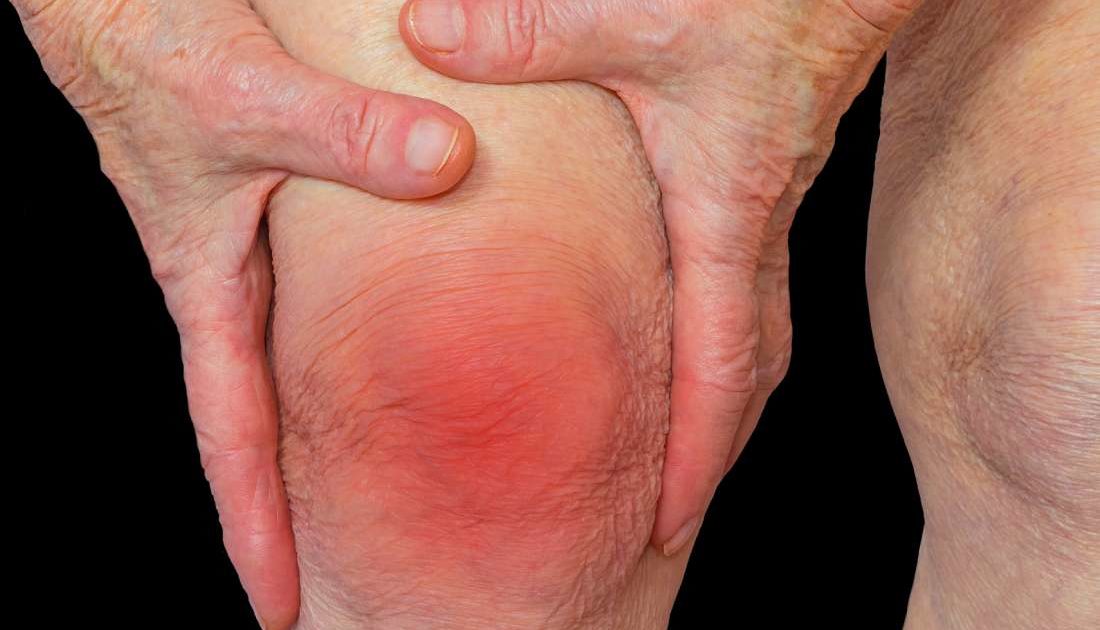 What is arthritis? What are its causes and symptoms?