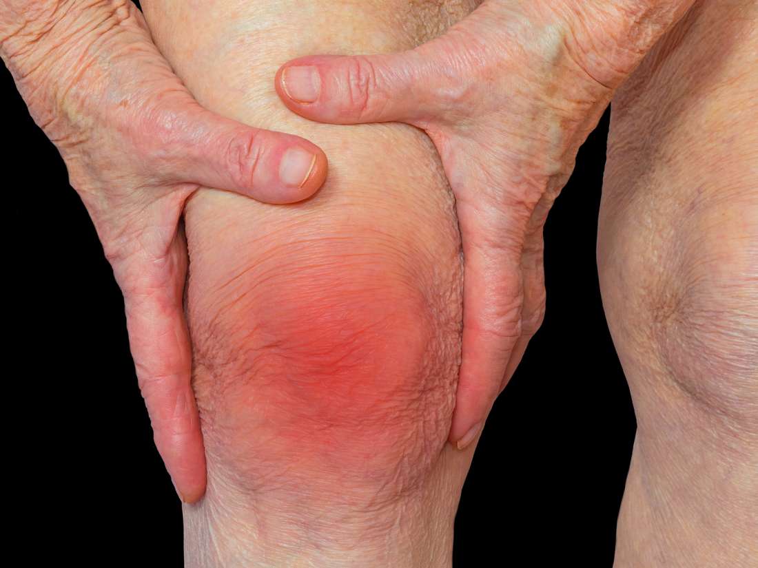 What is arthritis? What are its causes and symptoms?