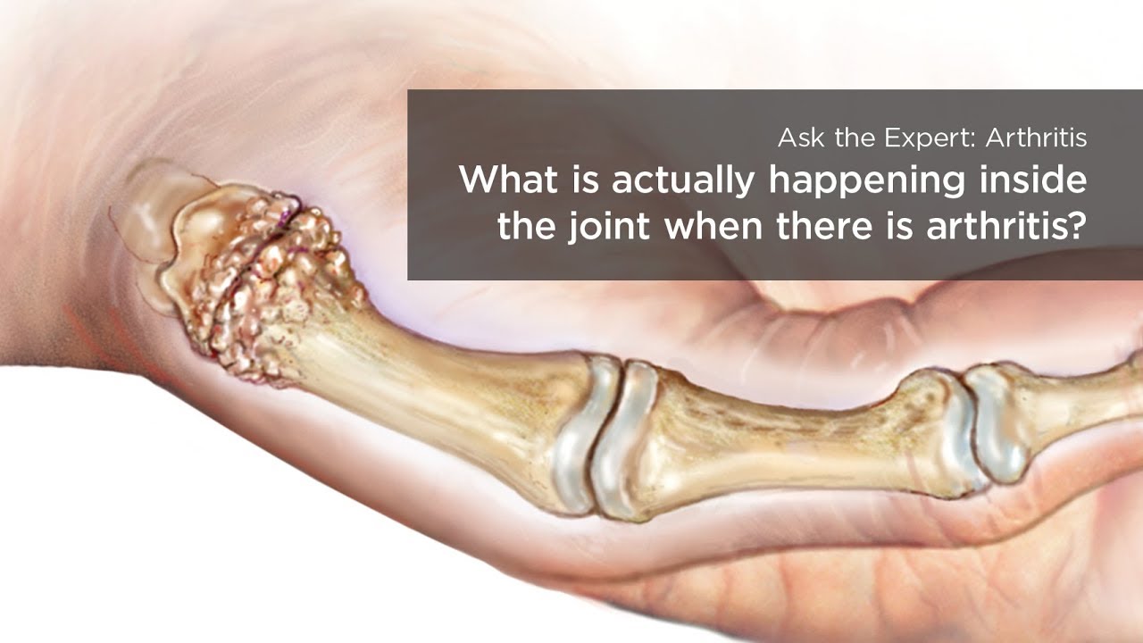 What is arthritis? What are its causes and symptoms?